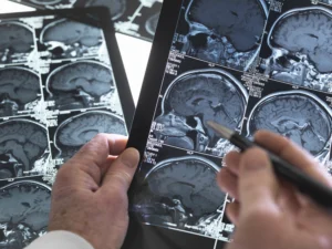 Acquired Brain Injury vs. Traumatic Brain Injury: Key Differences Explained by a Columbia Personal Injury Lawyer